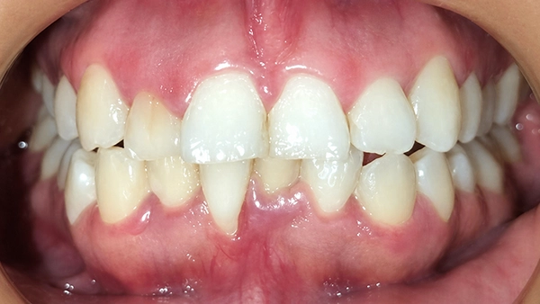 Antes del tratamiento Invisalign: sonrisa estrecha y dientes sin nivelar